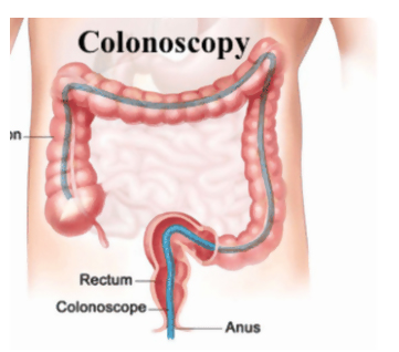 colonoscopy endoscopy procedure ready start